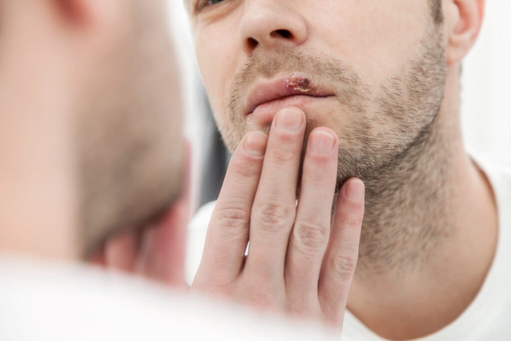 cold sore prevention