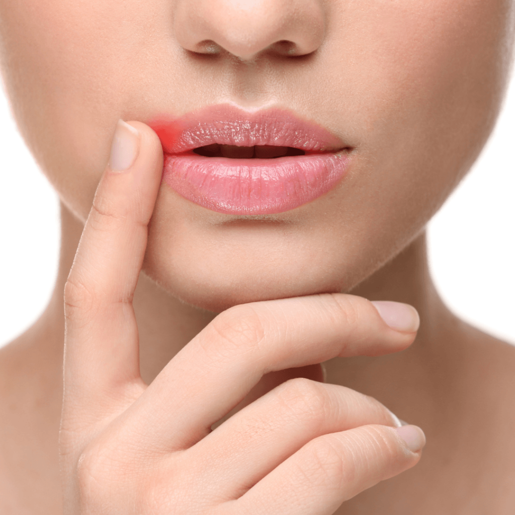 cold sores explained is it herpes on your lip