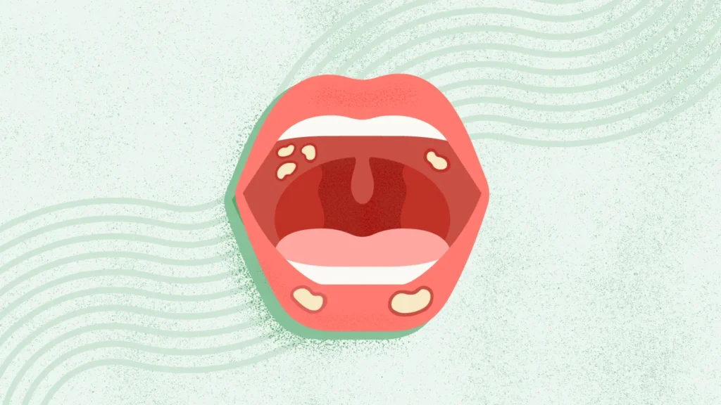 eh canker sore gg 1440x810